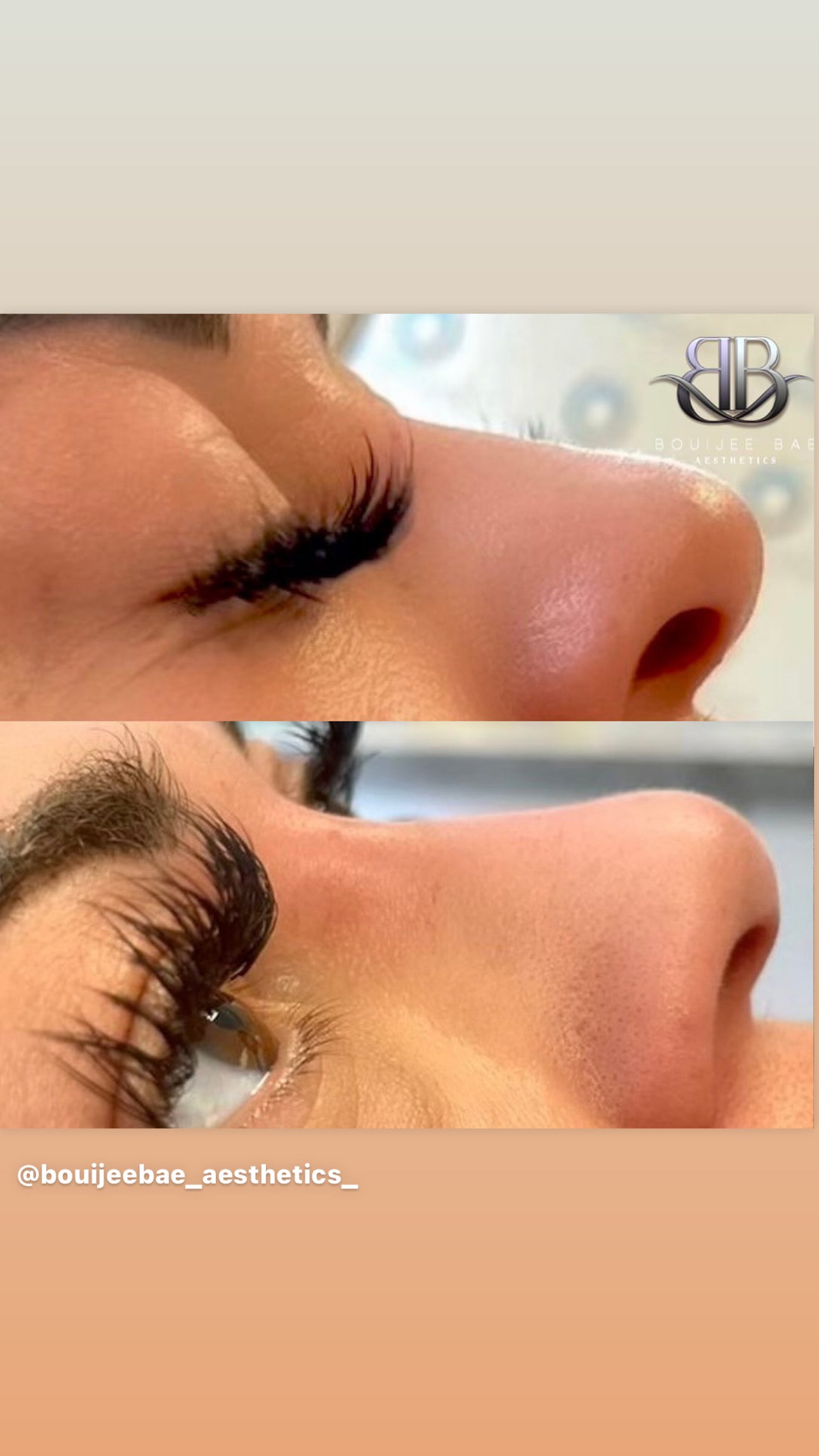 Non Surgical Rhinoplasty