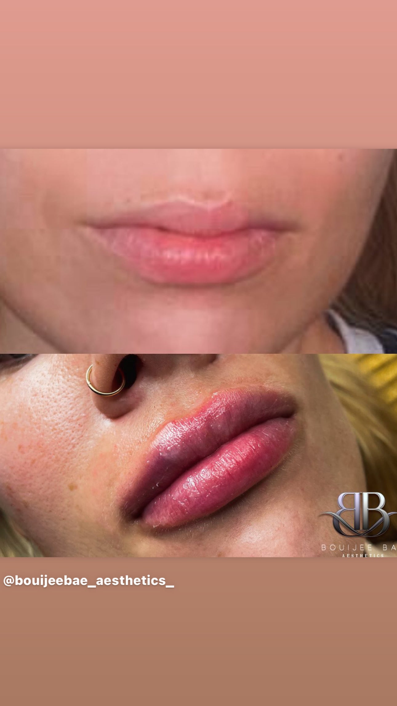 Volume Lip Filler