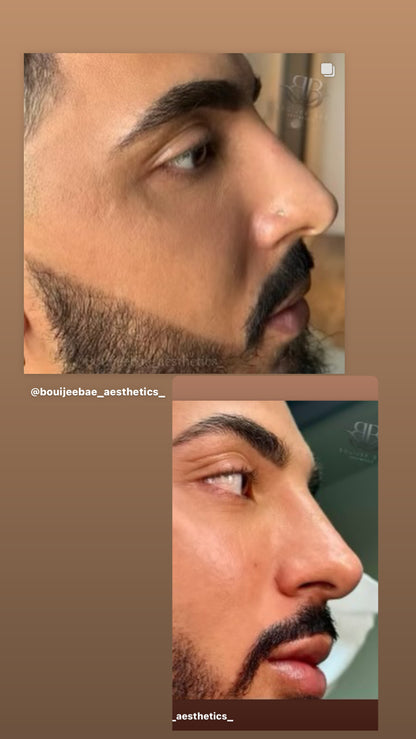 Non Surgical Rhinoplasty