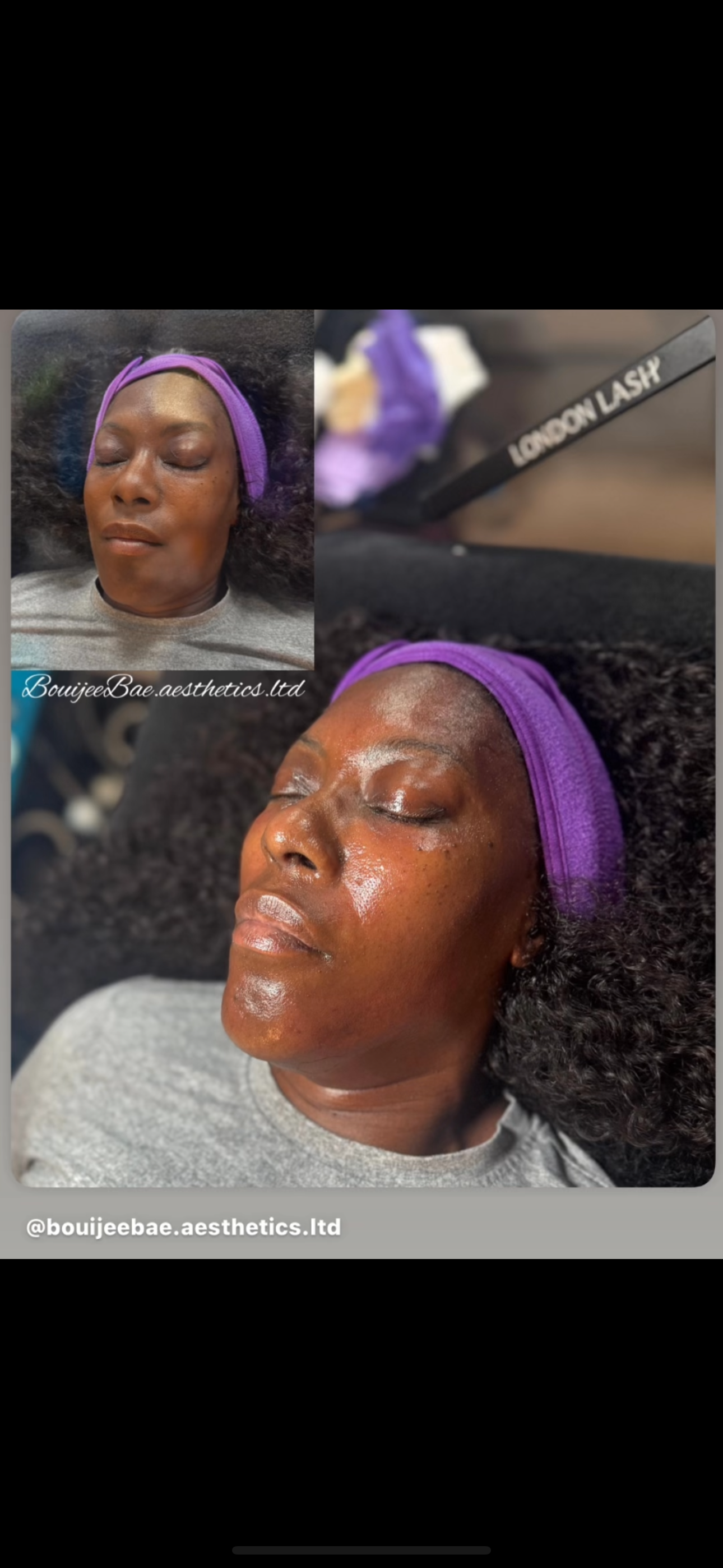 Bouijee Signature Facial (Hydrafacial + Microneedling)