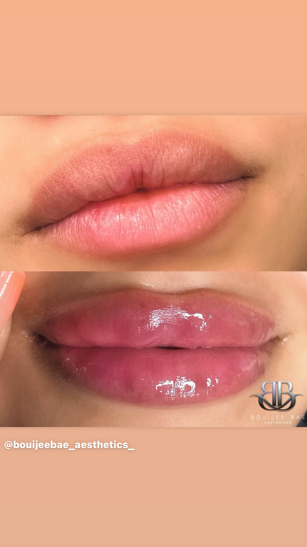 Volume Lip Filler