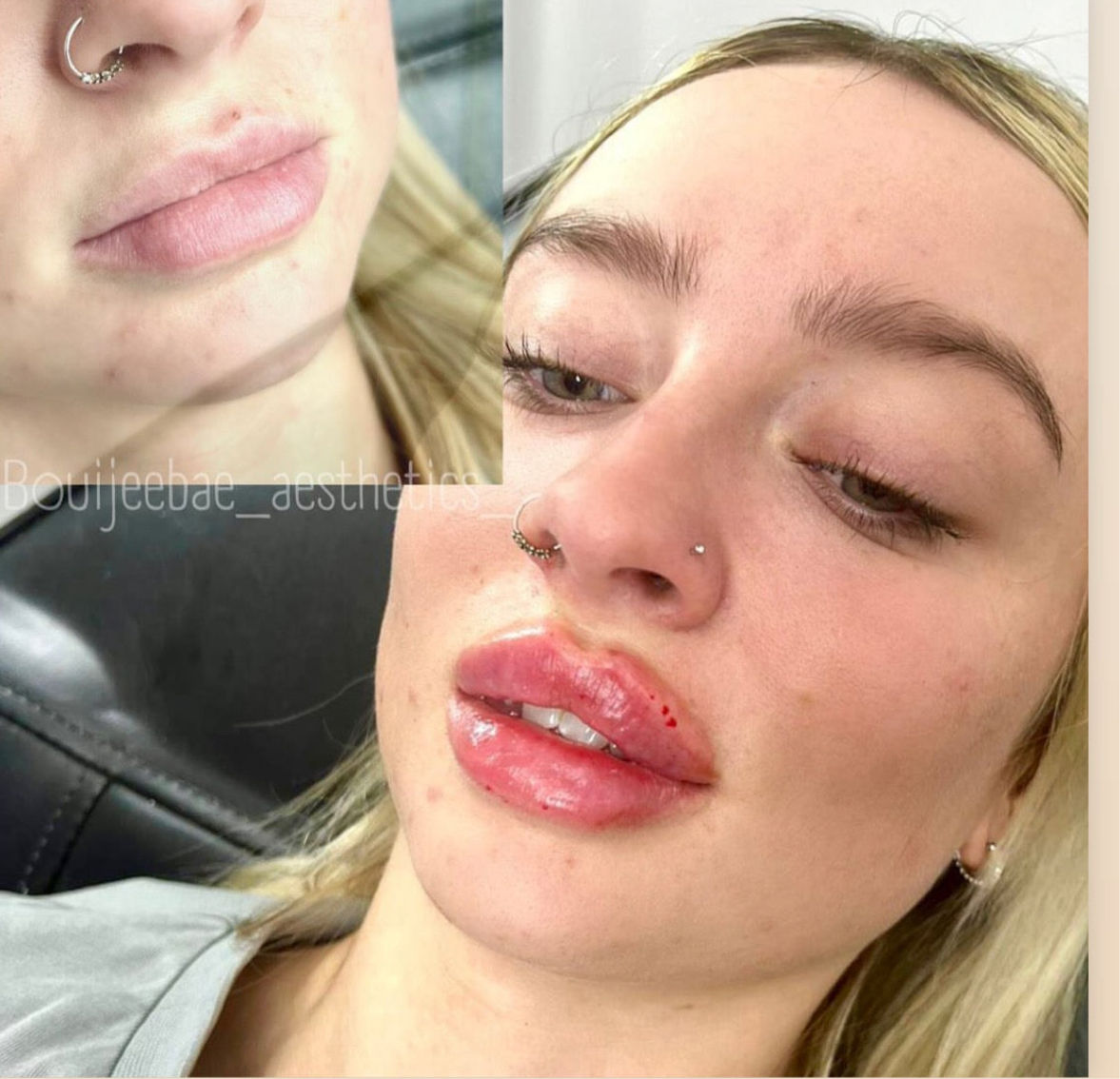 Volume Lip Filler