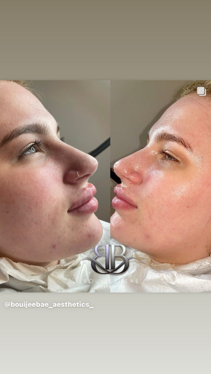 Million Dollar Facial (Dermaplane + Microneedling)