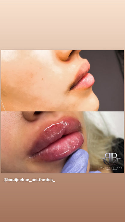 Volume Lip Filler