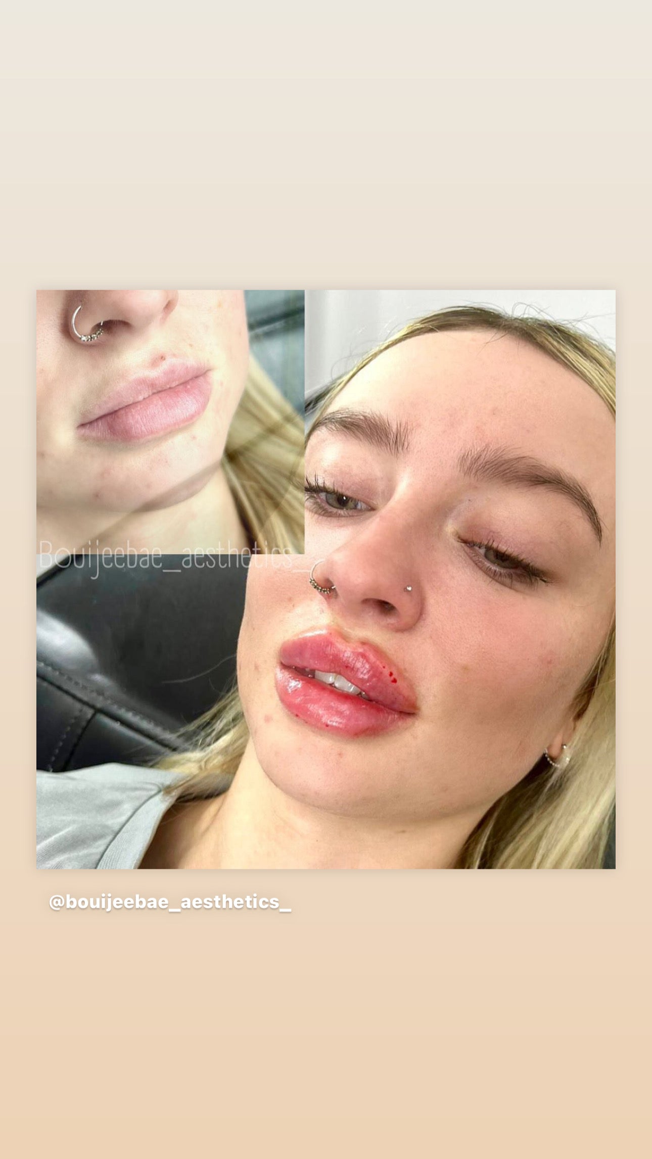 Russian Lip Filler